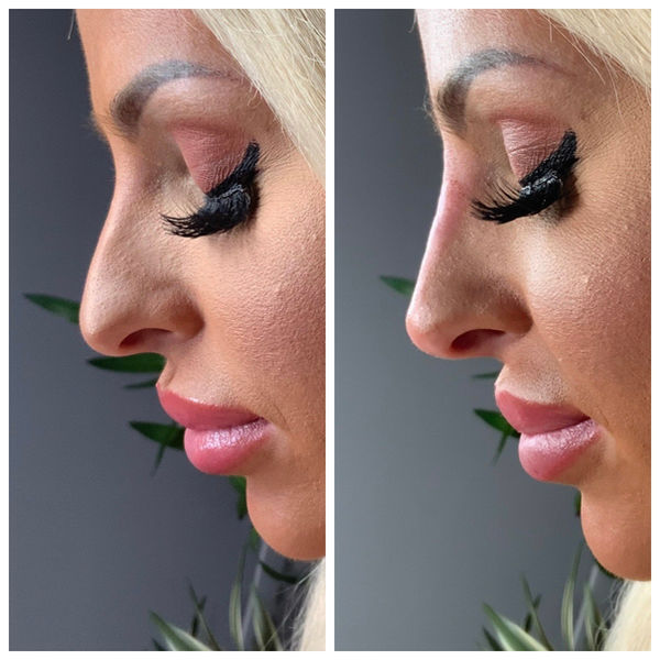 Non-surgical rhinoplasty treatment at KH Aesthetics