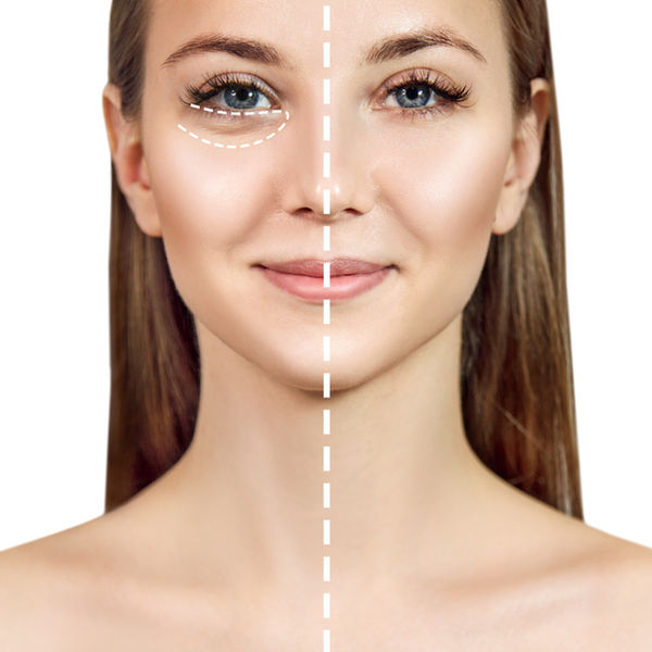 Tear trough treatment at KH Aesthetics